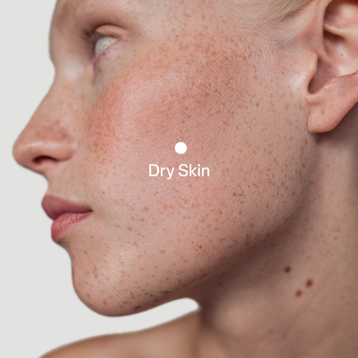 What Causes Dry Skin in Winter and How to Combat It
